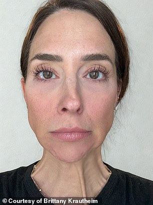 Brittany Krautheim, 41, from Maryland, injected the upper and lower areas of the left side of her face, including her forehead and crows feet. She's seen before the injections