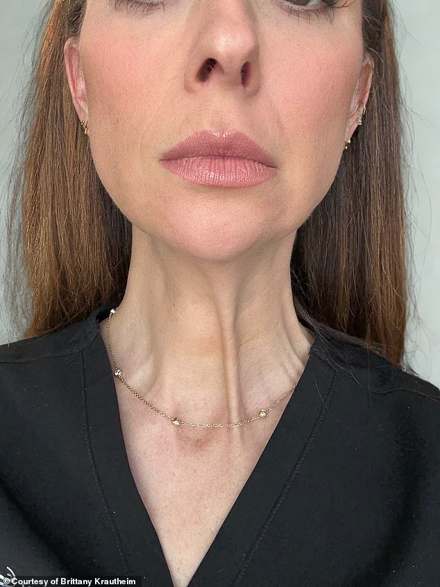 In the end, Brittany (seen after the injections) said she hopes people can use her experiment to make 'informed and educated' decisions when it comes to cosmetic enhancements