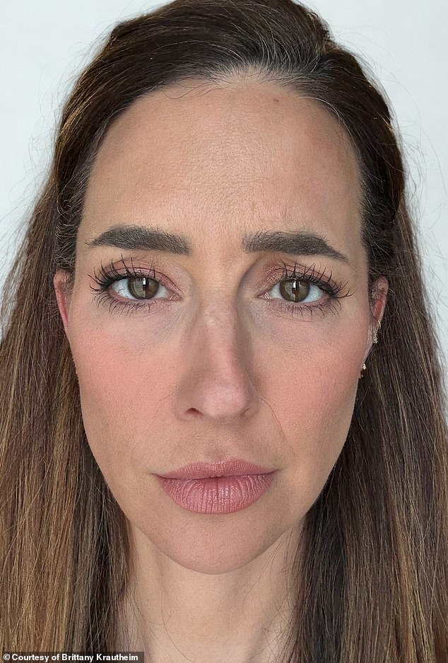 'I think the biggest misnomer about Botox is that it’s going to change how you look,' she explained. 'However, that’s not really the goal.' She's seen after getting the Botox