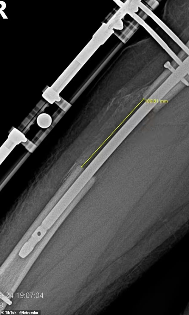 The excruciating and expensive cosmetic procedure involves breaking the legs, implanting magnetic rods, and slowly stretching them out over several months. Pictured, an x-ray of his thighbone after the first surgery
