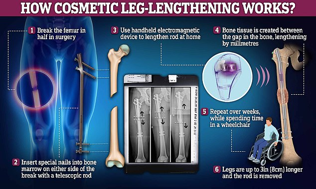 Nails are drilled into either end of each femur or tibia, which is slowly teased apart with magnets over weeks while it heals naturally, resulting in a longer bone. But it can leave patients in agony and wheelchair-bound during the process, with months of physiotherapy needed afterwards