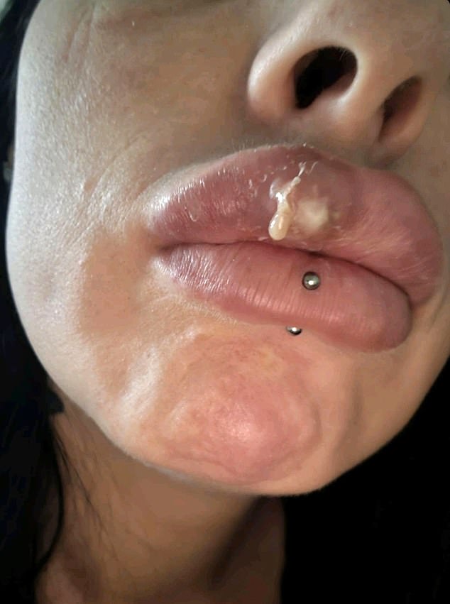 One of the distressing side effects of the filler was when Amy's lips started 'oozing' (pictured) as a result of the jabs