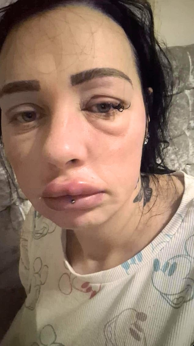 While Amy (pictured) experienced no side effects at first, at one point, lumps and swelling started to appear on her face