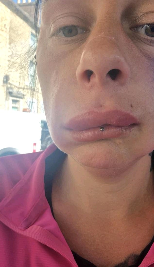 Amy (pictured) says: 'I looked in the mirror and looked disgusting, she [the injector] made me feel like I was ugly and nothing'