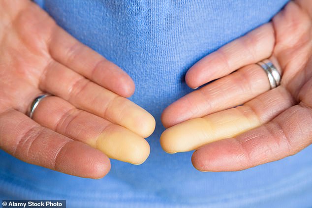 Raynaud’s syndrome causes a person’s extremities to become cold and numb, changing colour from white to blue then red
