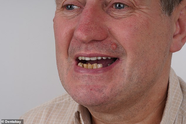 In desperation, Mr Lakey pulled out four of his lower teeth before flying to Turkey for a smile makeover