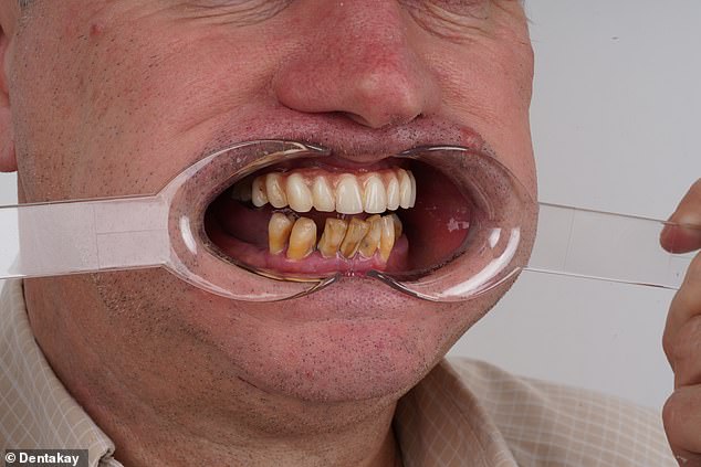 This photo, taken before his smile makeover, shows the painful gum disease which cost him his lower teeth
