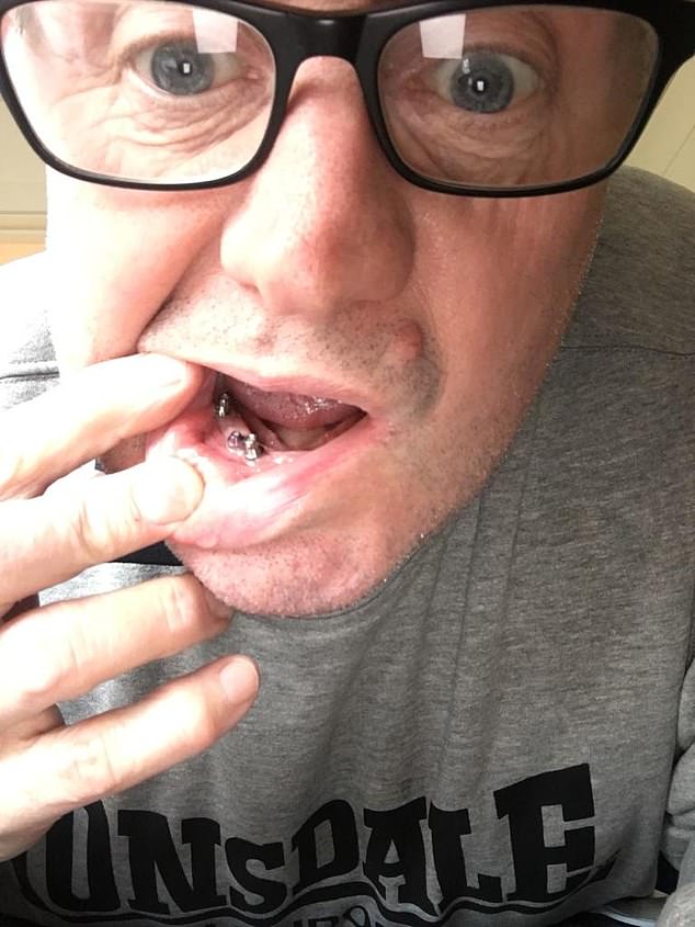 Mr Lakey shows off the implants which his veneers are securely anchored to