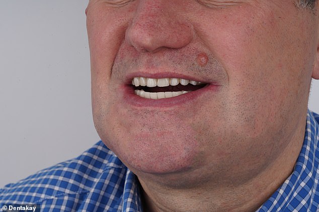 The £6,000 procedure saw him have veneers attached to ten implants in his jaw bones