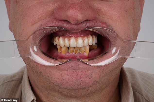 Mr Lakey had a plate fitted to his upper jaw by a private dentist in Bromley, twenty years after losing his upper teeth