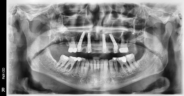 X rays show where the original plate was fitted, he has since had all of his natural teeth taken out and replaced them with porcelain veneers