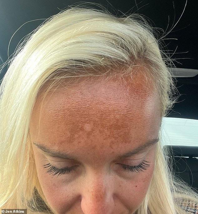 After using the spray only twice, Jen noticed dark splotchy patches appearing across her forehead
