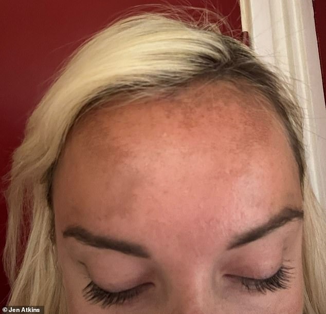 Years later, the pigmentation has gone away, although Jen says she's tried every possible product