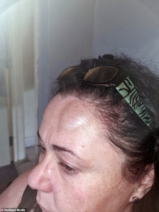 Gemma was subject to several attacks at Grundy's hands during their relationship, which left her with swelling and bruises