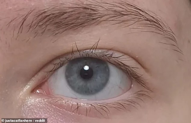 By way of comparison, the woman also included a picture of her eye that she'd taken just days earlier