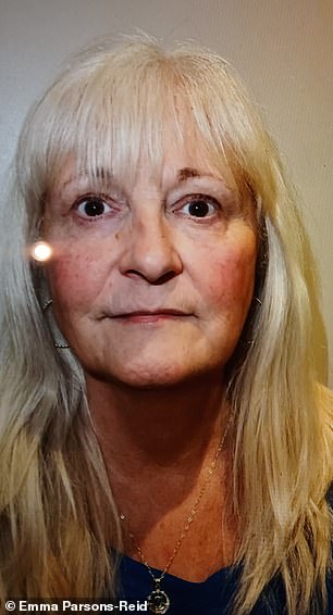 Emma after having fillers above her cheek bones and around her mouth
