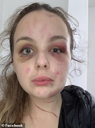 The fantasist backed up her lies with harrowing photos showing devastating injuries all over her face and body