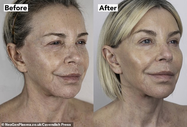 'Also, my eyes look so much better, they were hooded before and now you can see my eyes are completely a different shape. Then you come to the texture of my skin, and reduction of my pores,' she said