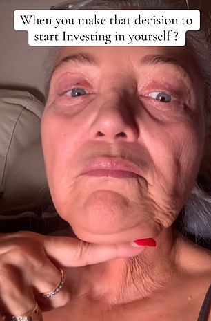 The loose skin on her neck before the procedure