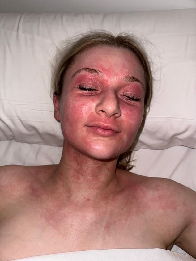 During the ten-hour flight to Dubai, the skin on Chloe’s face erupted. ‘I was in agony,’ she says. ‘When I got off the plane, people were staring at my bright red face’