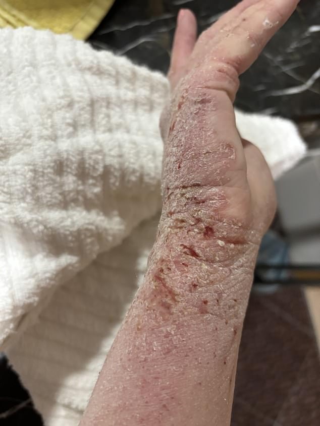 After 23 years of regular steroid use, Chloe – realising they were only damaging her skin further – stopped using the creams. By the following week, her skin had started to completely break down, weeping and peeling