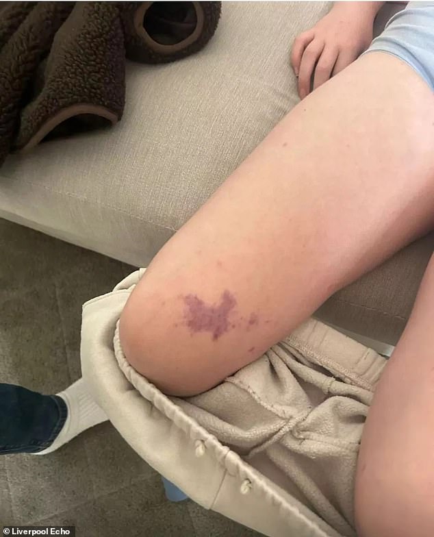 Her parents noticed this unusual purple rash which didn't fade under pressure from a glass