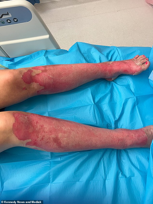 The burns covered 29 per cent of her body causing her skin to 'melt off' her body