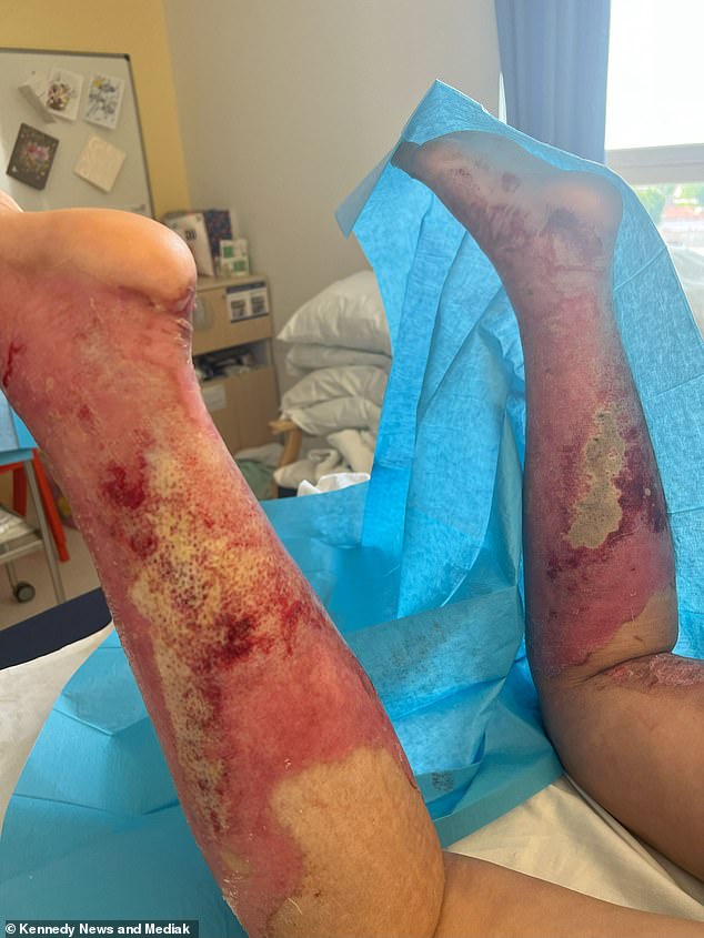 The mother-of-two said she was in a state of shock as her skin fell off her body as she sat in the shower