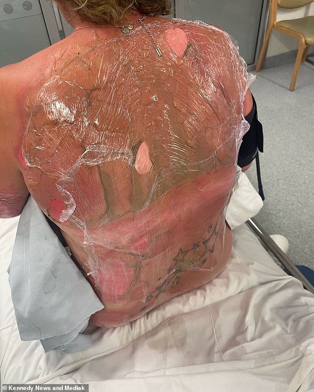 Emma spent a month in hospital and underwent ten skin grafts