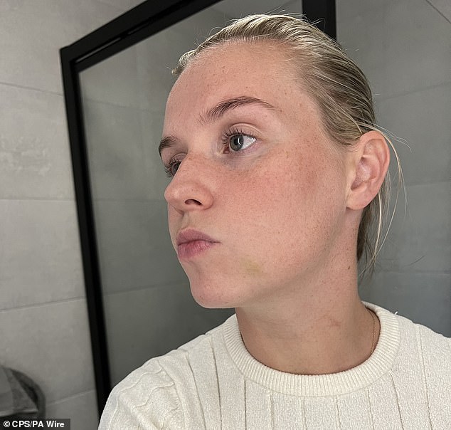 PC Ellie Cook's bruised face after she was punched by Mohammed Fahir Amaaz, now 20, while trying to arrest him for allegedly assaulting a passenger at Manchester Airport