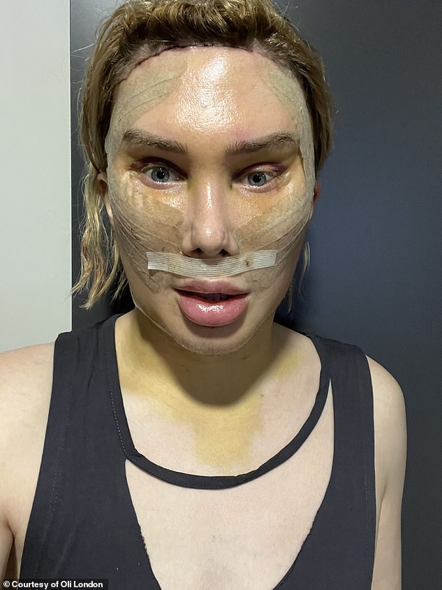 'This included shaving my bones in my forehead and eyebrows, more eye surgery, a facelift, a neck lift, a lip lift, having fat removed from my cheeks, and hairline lowering,' he shared