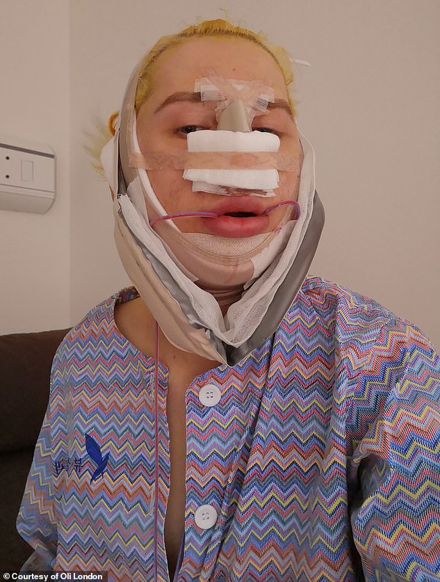 So in 2022, he came out as transgender and underwent a shocking 11 more procedures in one day to try to make himself look more feminine