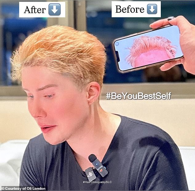 'Earlier this year, I also had a hair transplant,' he shared. 'With this procedure they actually harvested long hairs from the back of my head to my forehead, so I instantly had long hair'