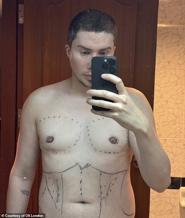 He's now in the process of 'reversing' his previous surgeries. He explained, 'I [had to] fix my body because I previously had two botched nipple surgeries and a bad gynecomastia surgery'