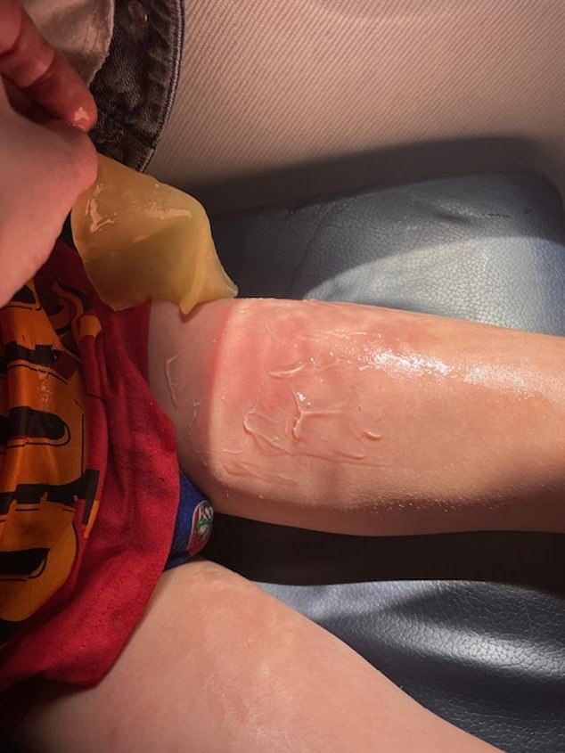 Harry's leg after the burn on board the flight. His mother claims that the cabin manager apologised and said the member of staff who served it was 'new'