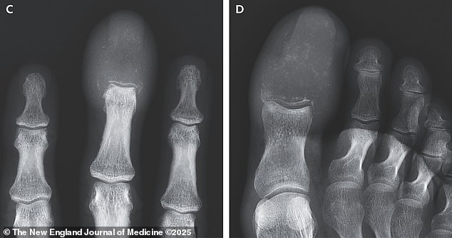 The above shows X-rays of the man's finger (left) and toe (right)