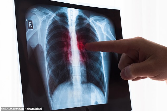 The unnamed man suffered from an aggressive form of lung cancer, doctors said (stock image)
