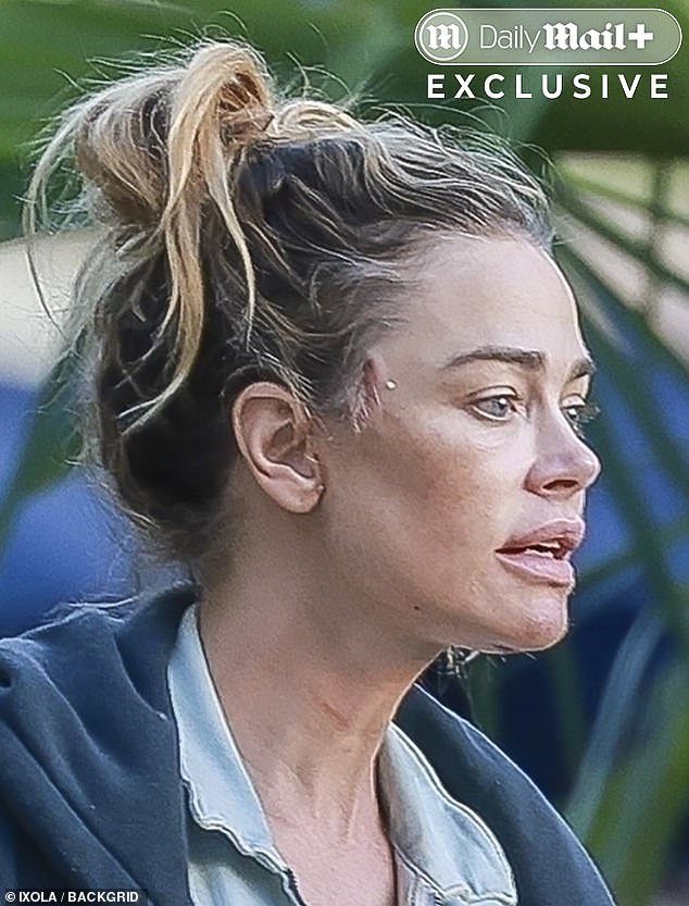Richards, 54, who has previously admitted to breast implants and Botox, showed off grisly temple incisions on both sides of her face during a low-key outing in Calabasas with daughter Sami Sheen, 21, on Tuesday