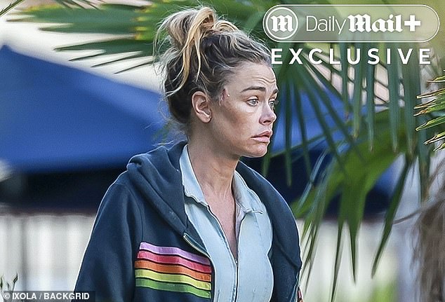 James Bond actress Richards also sported large bruises around her eyes, which appeared lifted