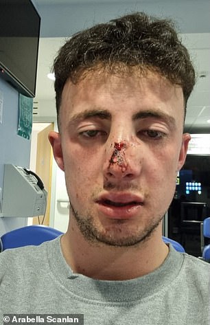 Harry is pictured with a swollen face after he was allegedly attacked by three men in the street