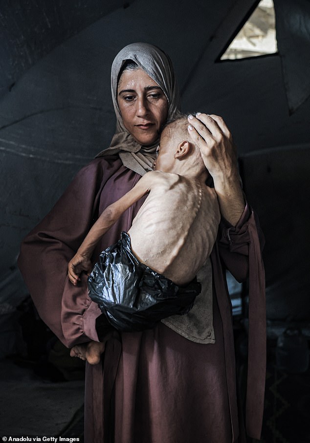 Aid agencies say Gaza is on the verge of famine, and that more than 100 have died in the last week. Muhammad Zakariya Ayyoub al-Matouq (pictured), an 18-month-old in Gaza City, is suffering life-threatening malnutrition