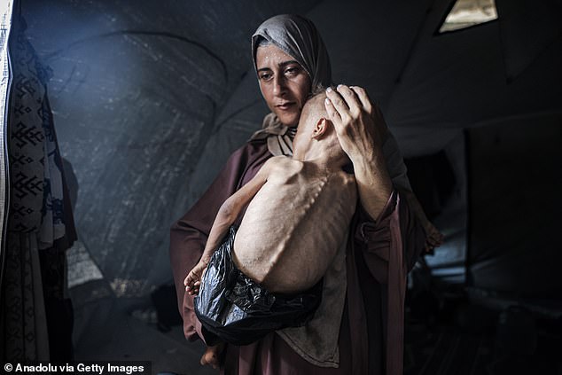 Muhammad Zakariya Ayyoub al-Matouq faces life-threatening malnutrition as the humanitarian situation worsens due to ongoing Israeli attacks and blockade, on July 21, 2025