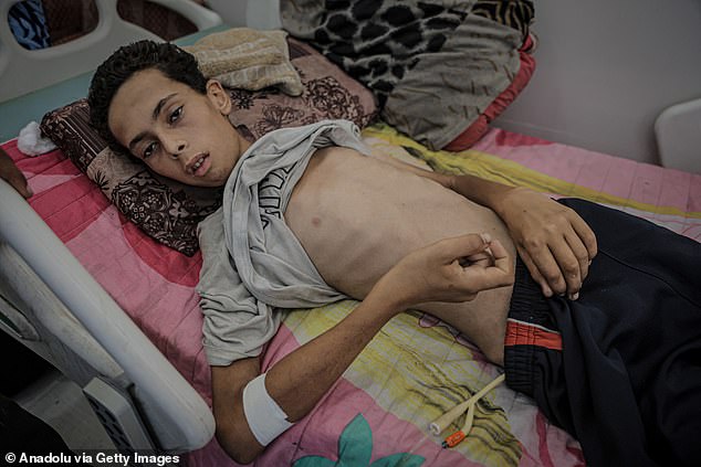 Palestinian teenager Atif Aid Abu Khater, weighing only 25 kilograms due to malnutrition, receives treatment under limited conditions at Al-Shifa Hospital in Gaza City, on July 25, 2025