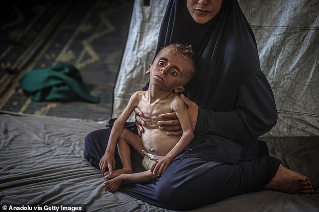 One-and-a-half-year-old Muhammed Zakariya Ayyub al-Matouk faces life-threatening conditions due to Israel's ongoing attacks and blockade in Gaza City, Gaza on July 24, 2025