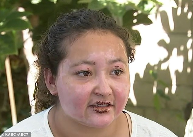 She has been left with scars and burn marks on her face and arms from the incident