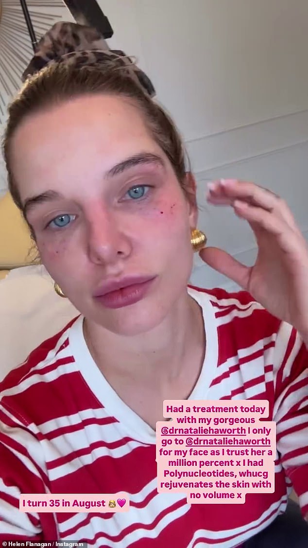 The TV star, 34, is understood to have acquired the bruising after having a round of £400 skin injections