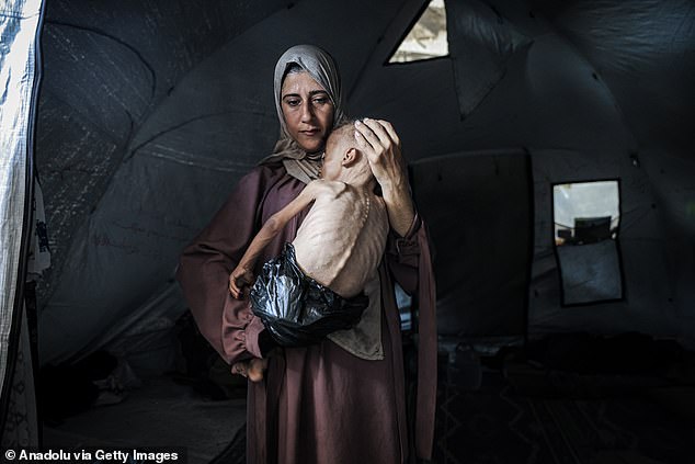 Muhammad Zakariya Ayyoub al-Matouq, a 1.5-year-old child in Gaza City, Gaza, faces life-threatening malnutrition as the humanitarian situation worsens due to ongoing Israeli attacks and blockade