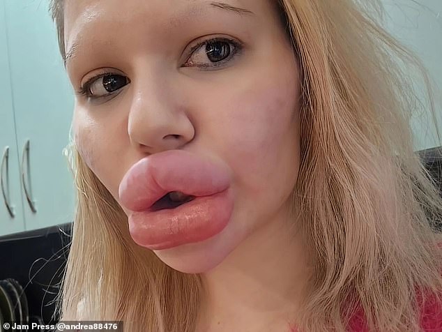 The 27-year-old regularly hits the headlines due to her enhanced appearance, which has seen her fork out an estimated £20,000 on lip filler alone