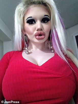 Andrea after surgery and filler