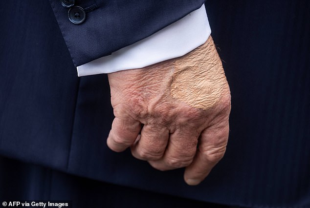 White House press secretary Karoline Leavitt says that Trump has been diagnosed with 'chronic venous insufficiency'